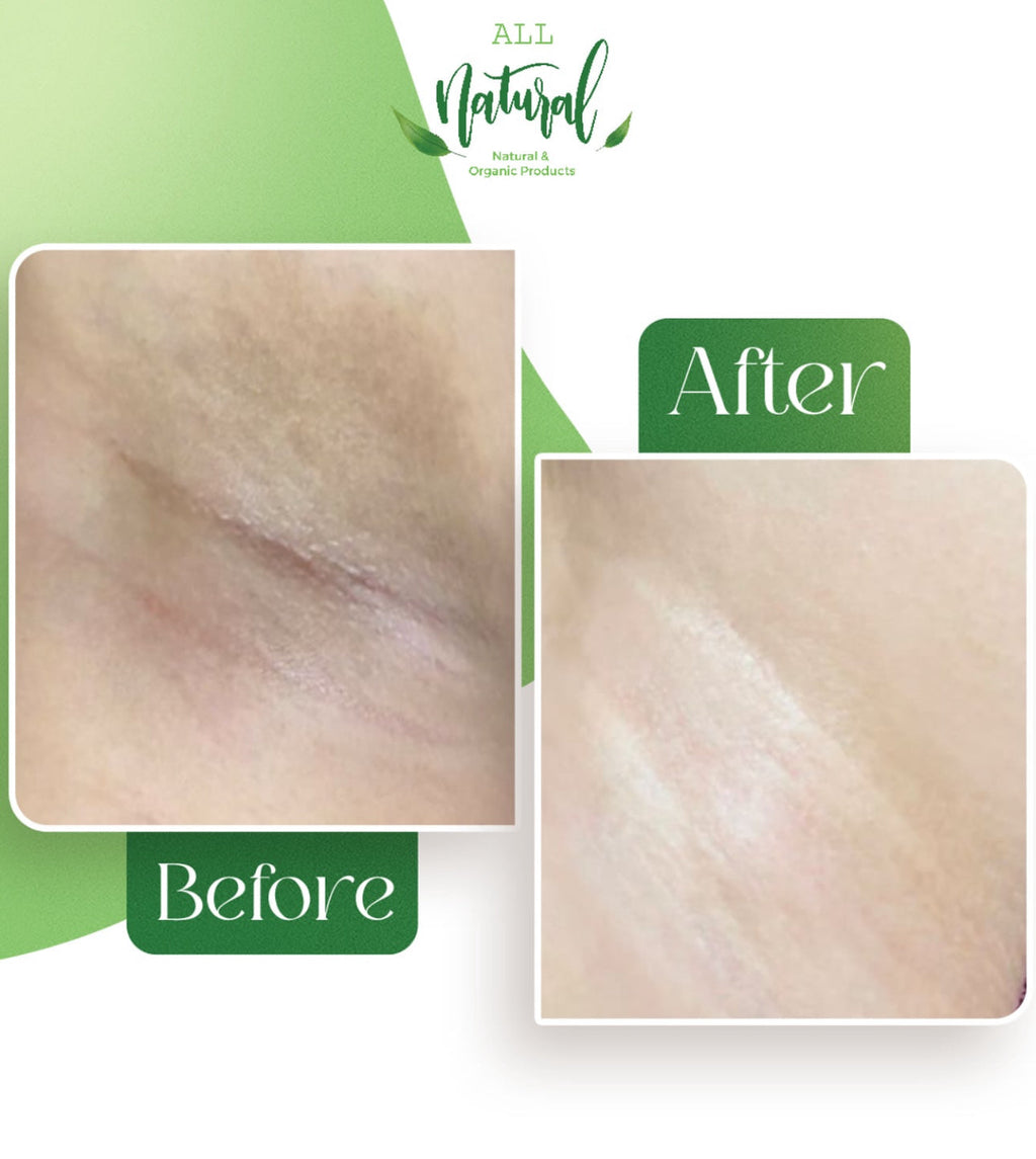 Before and after using All Naturals Intimate Whitening Cream