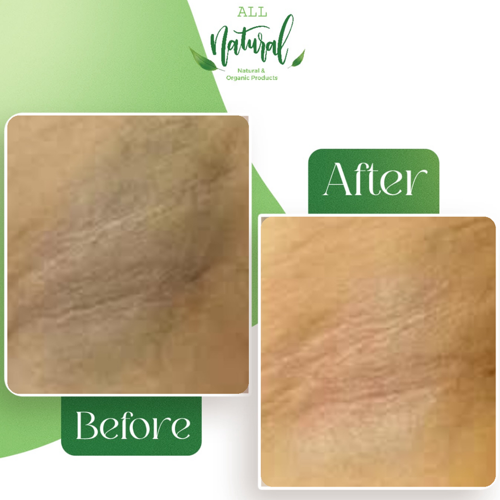 Before and after using All Naturals Intimate Whitening Cream